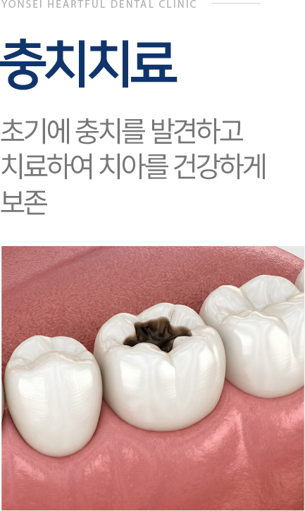 충치치료