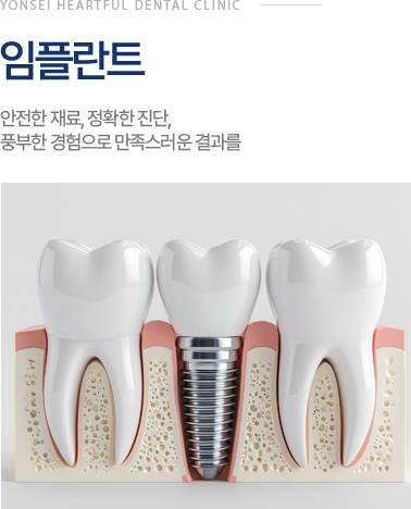 임플란트