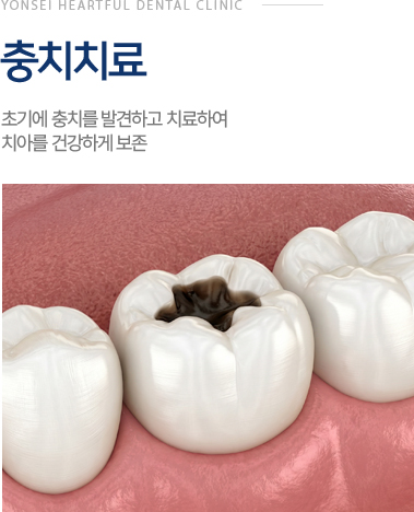 충치치료