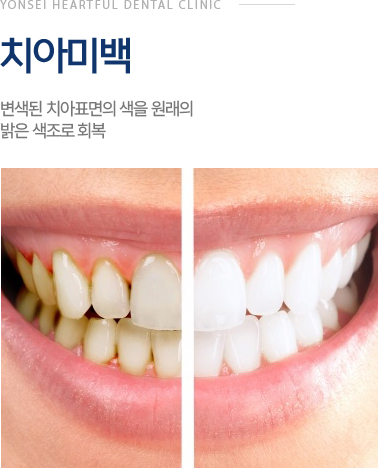 치아미백